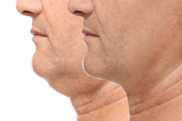 HIFU - Breakthrough in Anti - ageing 2 hifu results Chigwell