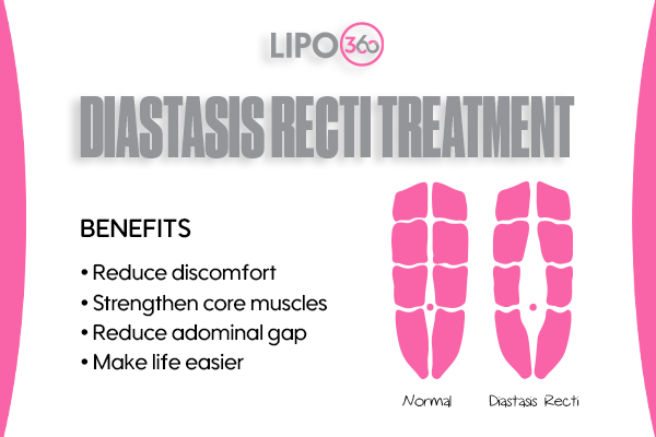 Revolutionising Muscle Repair: The Power of LIPO360 Body Sculpt Post-Injury 5 diastasis recti treatment Chigwell