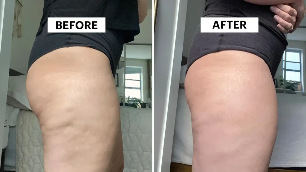 Do Toning Exercise Chigwell Really Tackle Cellulite?