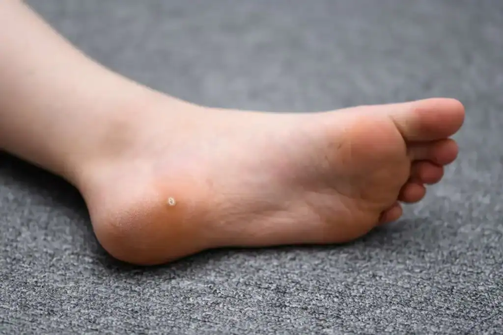 Cryotherapy For Warts And Also Verrucas 2 Image of verruca on the bottom of the foot that able to be treated with Cryotherapy Chigwell