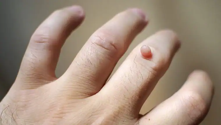 Cryotherapy For Warts And Also Verrucas 1 Image of blemish that Cryotherapy Chigwell can remove with Lipo 360.