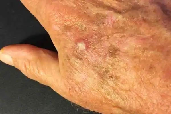 Image of Actinic keratoses Chigwell on a person hand