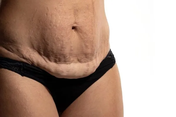 The science behind skin tightening Chigwell picture of a woman's sagging skin on the stomach
